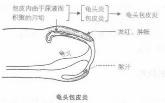 包皮龟头炎